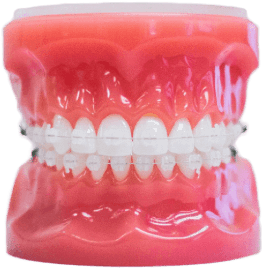 Clear Braces